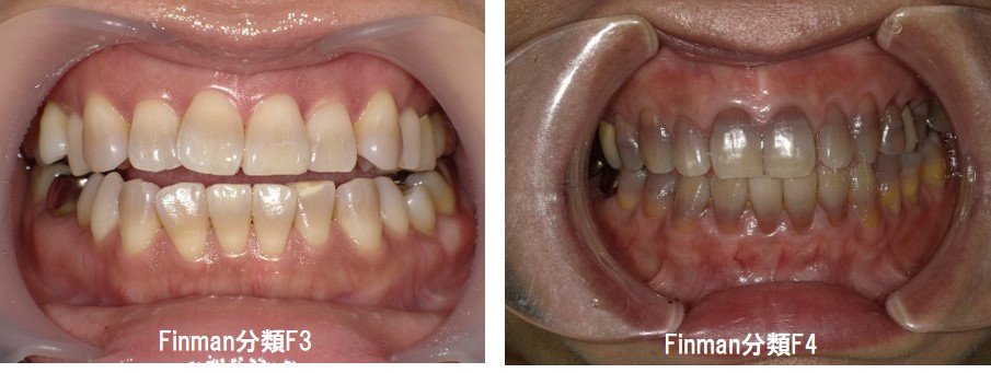 テトラサイクリン歯の事例画像