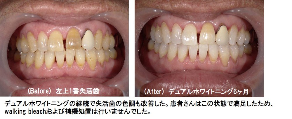 失活歯のホワイトニング症例