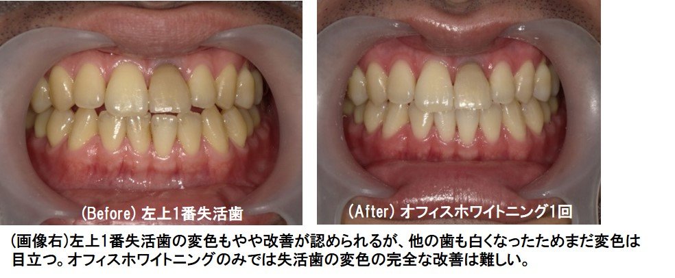 失活歯の事例画像