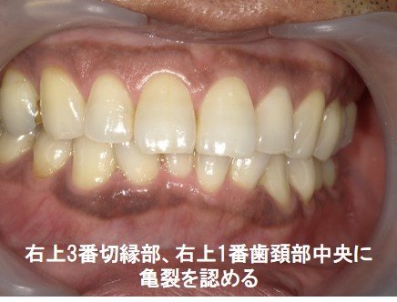 歯の亀裂（クラック）
