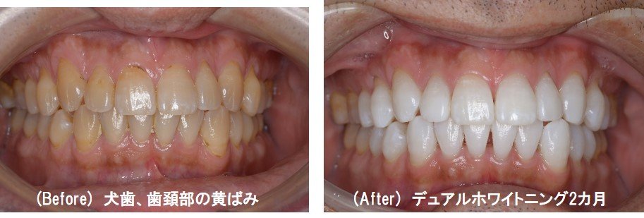 犬歯・歯頚部の黄ばみのホワイトニング症例