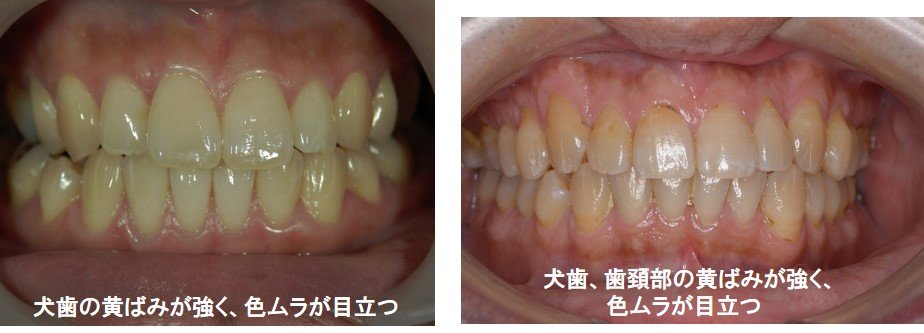 犬歯・歯頚部の黄ばみの事例画像